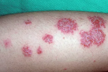 Nummular eczema. Nummular eczema is a chronic, inflammatory dermatitis that created round, coin-shaped itchy spots on your skin. It can be brown, red, or pinkish and may be scaly or ooze. You may need to see a doctor about getting relief.