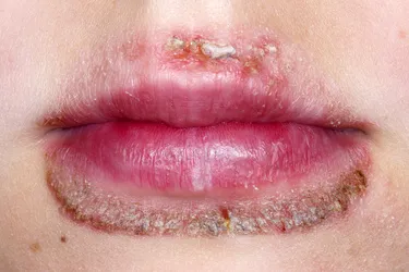 Perioral dermatitis causes bumps around the mouth, other areas of your face, and sometimes your genitals. (Photo Credit: Dr P. Marazzi/Science Source)