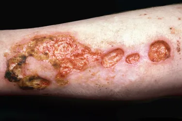 Polyarteritis nodosa. Polyarteritis nodosa (PAN) is a rare autoimmune disease that affects your blood vessels, causing them to swell and their walls to weaken. Your skin may develop bumps, change color, and even have open sores.