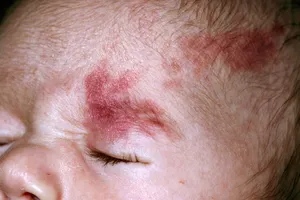 Port-wine Stain on Infant. Port-wine stains are permanent and often unsightly types of birthmarks which show up at or soon after birth. They are caused by an abnormal distribution of blood vessels called haemangiomas. They are harmless but can be a cause of embarrassment for some depending on the size or location. .They can be lightened by multiple laser surgeries.