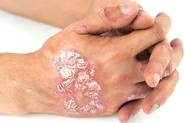 Plaque psoriasis is the most common form of psoriasis. It commonly appears as red, silvery-scaled plaques, as shown here on this male's hands. A chronic disease, it goes through cycles of flares and remissions.