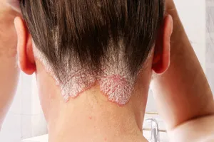 On light skin, scalp psoriasis may show up as pink or reddish patches with white scales. 