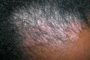 On darker skin tones, scalp psoriasis may have purple undertones with gray scaling. 