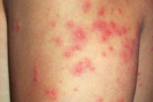 What Are Sea Lice?