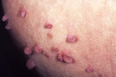 Skin Tags (acrochordons) are benign skin growths that affect about half of all adults. Doctors aren't sure just what causes them, but skin friction can play a role.
