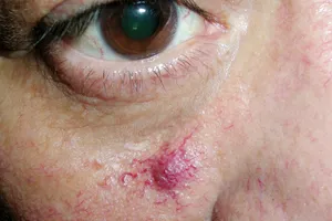 Spider angioma or spider nervus is a common development of small blood vessels. Its name comes from its appearance which generally has a central red blood vessel with small capillaries radiating from it so that it resembles a spider.  The vascular cluster is benign and poses no harm.