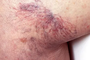 Spider veins twist and turn and look like a spider’s web or tree branch. They are usually red, purple, or blue and easily visible through the skin. They are most often found on the legs and face.