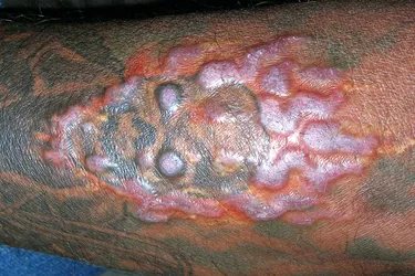 Tattoo Allergic Reaction. It is possible to have reactions to the inks or the metals in the needles used in tattoos, causing swelling and even damage to the skin tissue itself. Allergies to the red dyes are most common. This person is having an allergic reaction to the red used in the flames around the skull tattoo.