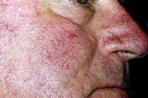 Telangiectasias are clusters of small, widened blood vessels which develop near the surface of the skin of mucous membranes. They are commonly known as spider veins.
