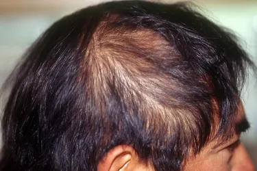 Telogen effluvium (TE) is the thinning of hair due to stress. (Photo Credit: Science Source)