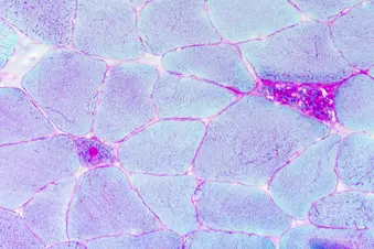 photo of pompe disease