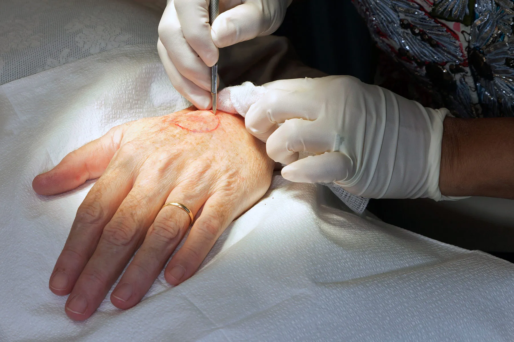 basal cell carcinoma