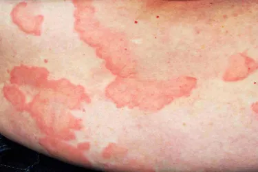 Urticaria, also known as hives, is a skin rash of raised, itchy bumps. The welts may also burn or sting. They often last hours or days, can move around, and don't leave lasting skin changes. Viral, bacterial, or fungal infections may trigger hives, and they frequently happen again.