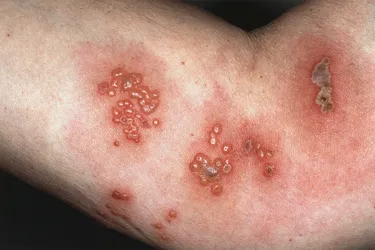 The varicella-zoster virus is responsible for both chickenpox and shingles. It creates rash of blisters with a red base that can be painful and itchy. It's also very contageous. Once the virus is in your body, it never goes away and it can appear later as shingles.