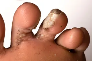 This photo shows common warts (verruca vulgaris) on the toes of a teenage boy after treatment with salicylic acid. 
