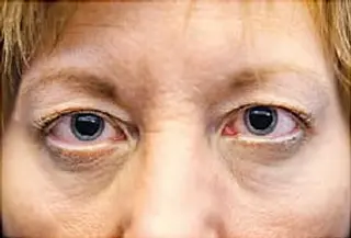 woman with dilated pupils