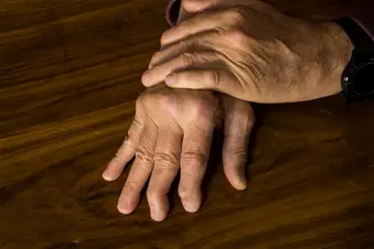 photo of arthritis