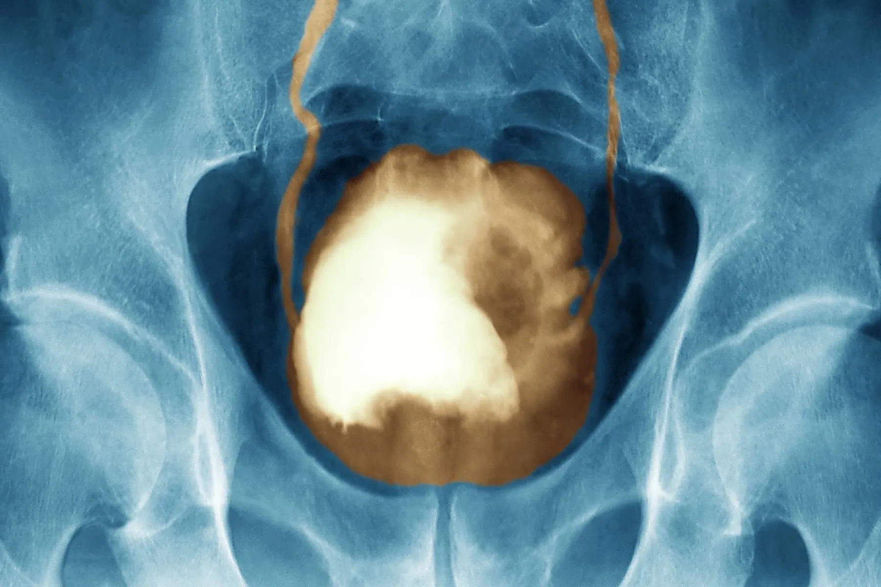 bladder cancer x-ray