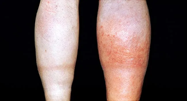 4 Blood Clot Symptoms Not To Ignore - Vimarsana News