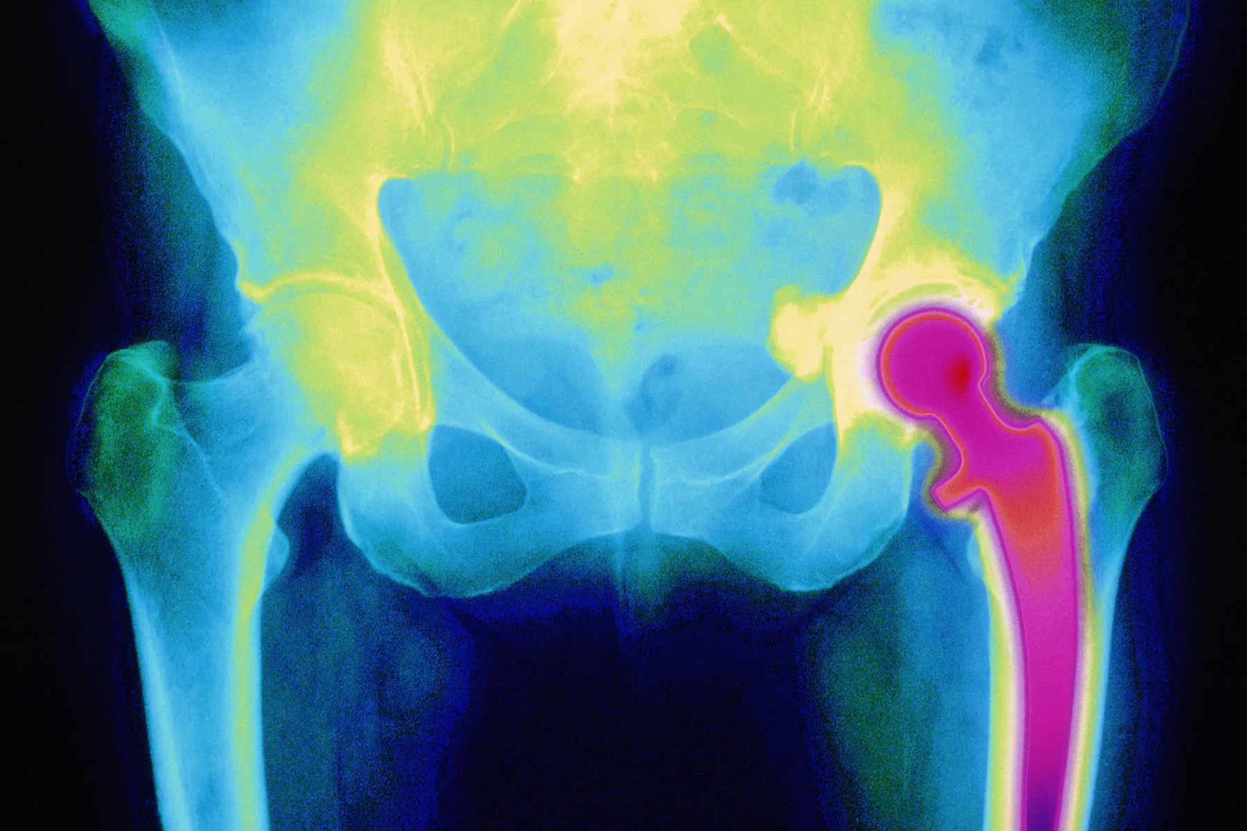 photo of hip replacement mri