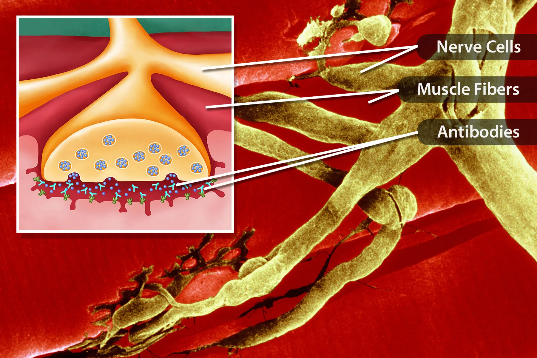 Pictures Guide To Myasthenia Gravis 5110