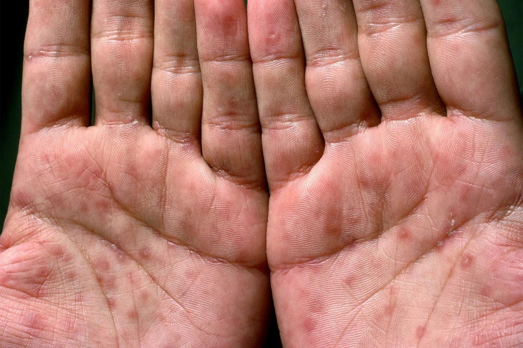 HIV And AIDS Rashes And Skin Conditions   1800x1200 Hiv And Aids Rashes And Skin Conditions Slideshow 