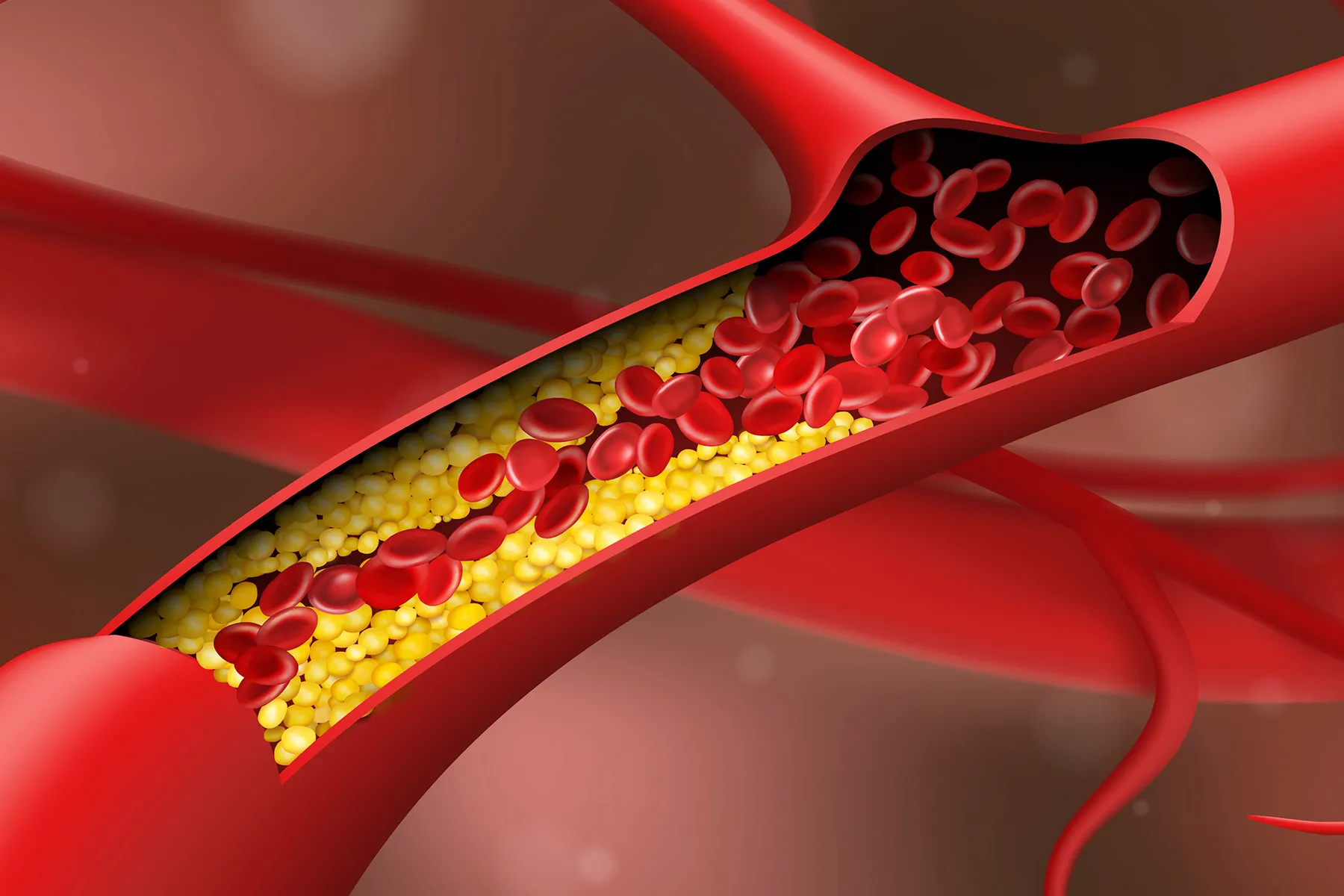 A visual guide to coronary artery disease (CAD) with information on 