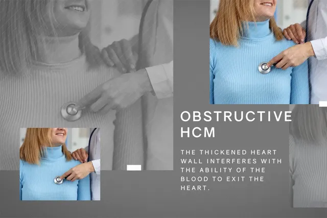 Obstructive vs. Nonobstructive HCM