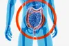 photo of Crohn's Disease anatomy