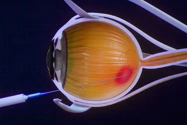 How Different Treatments for Wet AMD Work