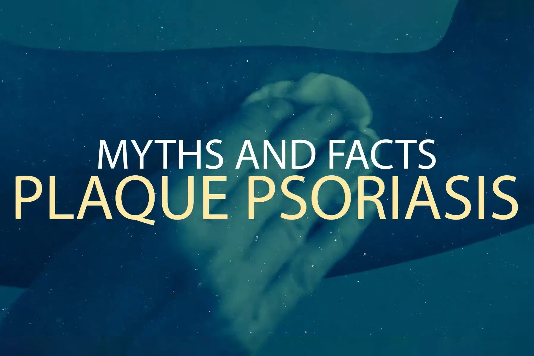 Myths and Facts Plaque Psoriasis