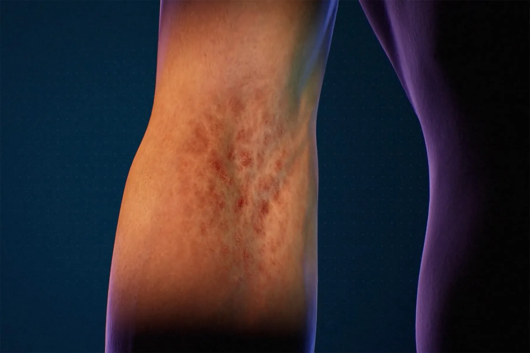 How Treatments for Severe Atopic Dermatitis Work