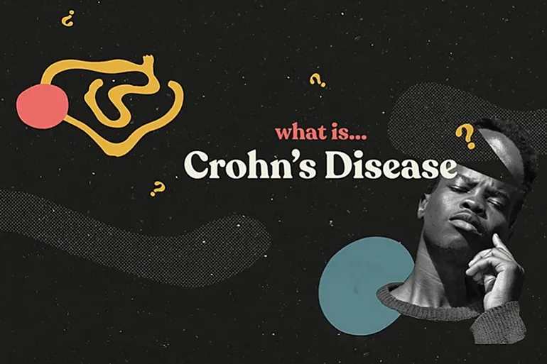 What Is Crohn’s Disease?