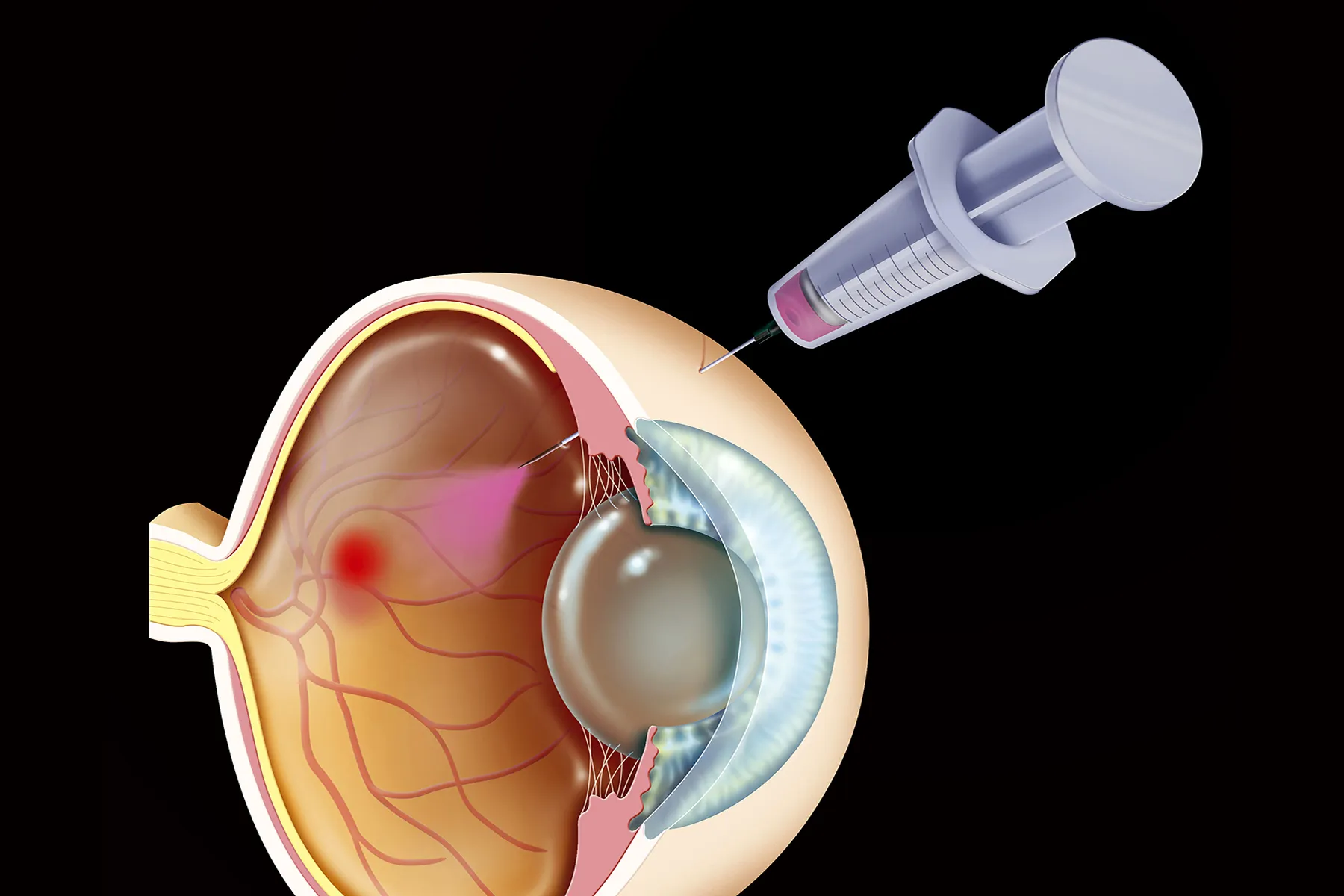 How different treatments for wet amd work