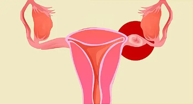 illustration of ectopic pregnancy