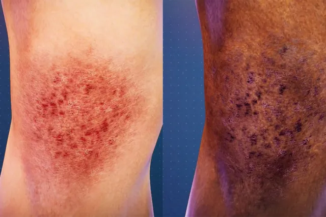 The Differences of Atopic Dermatitis on Skin of Color