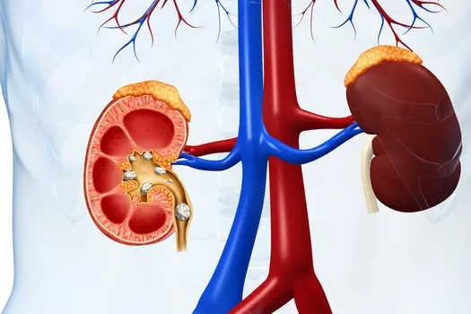 kidney stones illustration