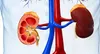 kidney stones illustration