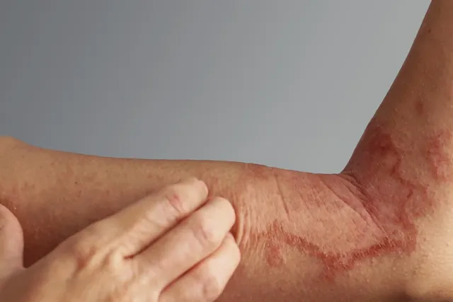 Why You Shouldn’t Scratch That Itch 