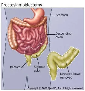 Proctosigmoidectomy