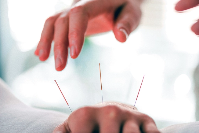 Acupuncture