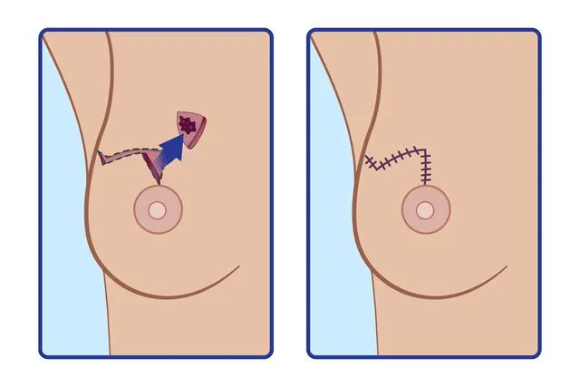 Flap Reconstruction Options