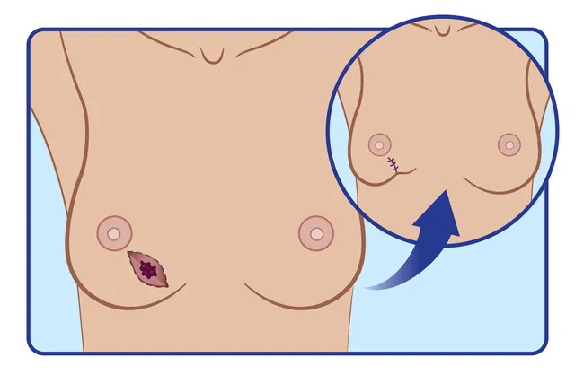 Mastectomy vs. Lumpectomy