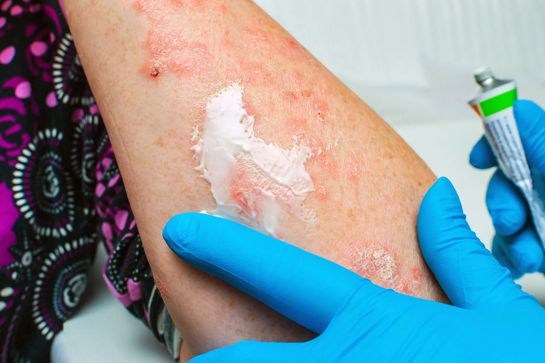 Plaque Psoriasis Nonsteroidal Topical Treatments 