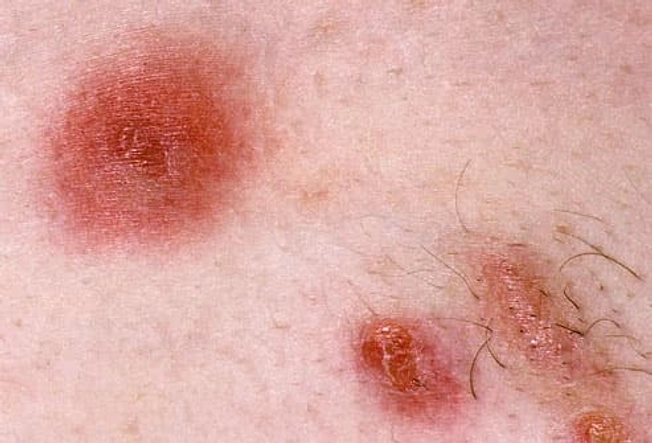 MRSA Skin Infection: Signs & Symptoms