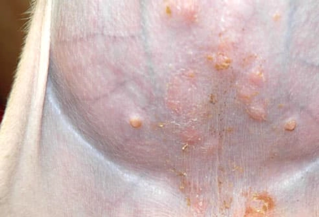 Impetigo