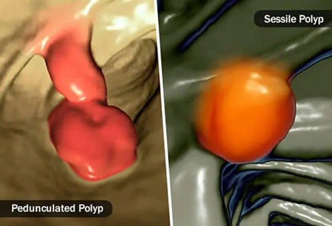 What’s a Polyp?