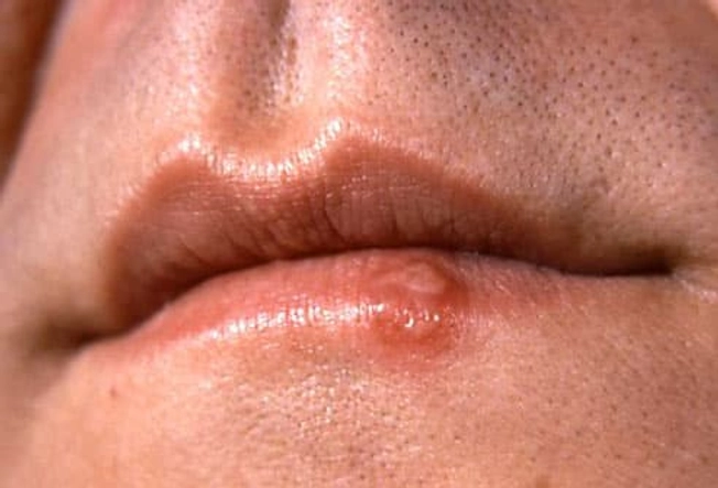 Cold Sores (Fever Blisters)