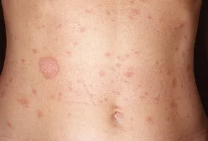 Pityriasis rosea is a harmless, common skin problem that causes a rash. (Photo credit: Interactive Medical Media LLC)