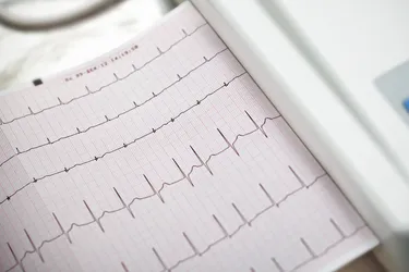 One of the tests you might have for atrial fibrillation, or AFib, is an electrocardiogram (EKG). It measures how fast your heart is beating and can tell whether your heart is in rhythm. (Photo Credit: sudok1/Getty Images)